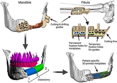 Patient-Specific 3D-Printed Miniplates for Free Flap Fixation at the Mandible: A Feasibility Study